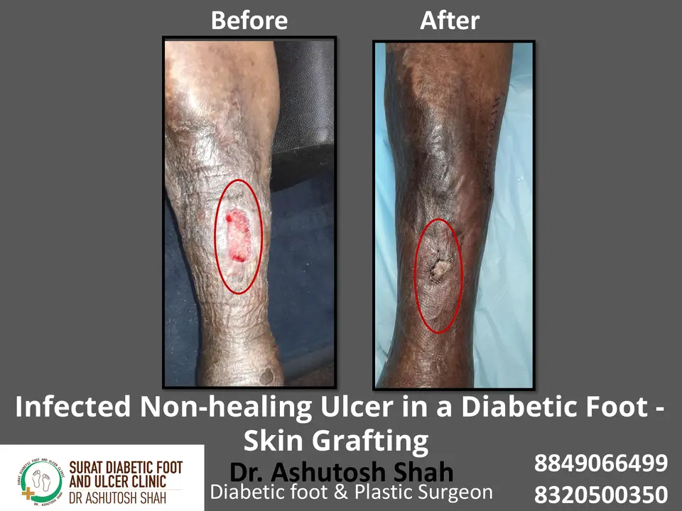 Diabetic Foot  PPT 3 checked by sir.pptx-8.webp